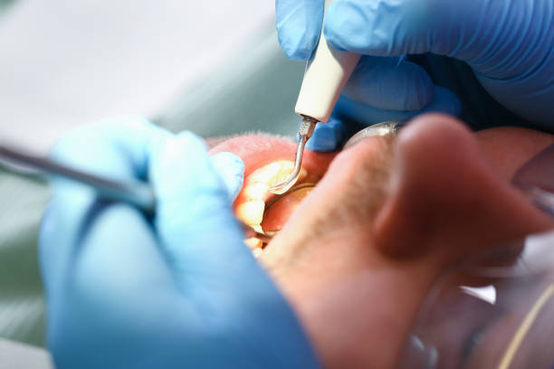 Best Emergency Dentist for Lost Fillings or Crowns in De Motte, IN